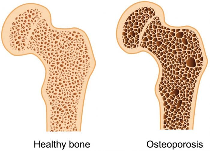5. Mencegah Osteoporosis